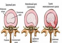 How to treat a herniated disc and what are the causes of its occurrence