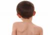 Vaikų skoliozės gydymas Vaikų stuburo kreivumo požymiai