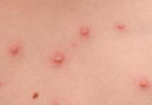 Signs and symptoms of syphilis
