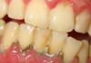 Ako sa rýchlo zbaviť červených škvŕn v ústach Podráždenie ústnej sliznice