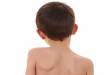 Treatment of scoliosis in children Signs of curvature of the spine in children