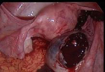 Ovarian apoplexy: sintomas, paggamot at kahihinatnan